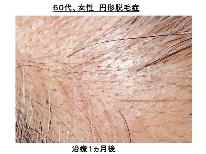 円形脱毛症　病院